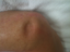 Pitting Edema Swelling Fracture Humerus Manual Soft Tissue Mobilization