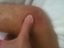 Manual Mobilization Pitting Edema Lymphatic Drainage Soft Tissue Edema Swellling of elbow fracture