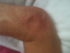 Pitting Edema Swelling Fracture treatment myofascial mobilization
